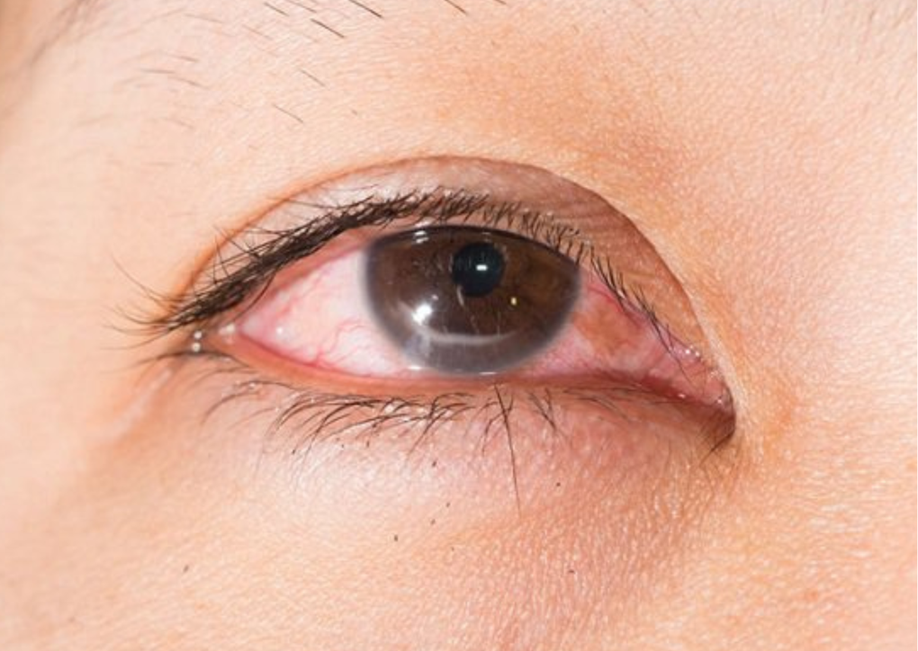 Gạc lau mi mắt Ocuvane Plus - sản phẩm chuyên dụng cho người bị viêm bờ mi, khô mắt - 1 Gạc lau mi mắt Ocuvane Plus - sản phẩm chuyên dụng cho người bị viêm bờ mi, khô mắt - 1