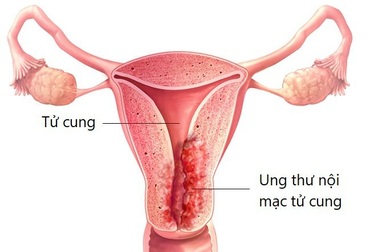 Các triệu chứng của ung thư nội mạc tử cung