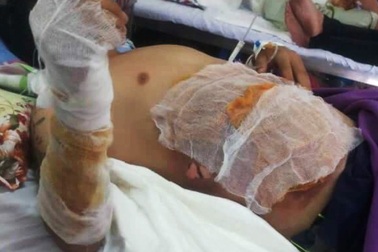 “Cần thủ” bỏng nặng vì câu cá dưới đường điện cao thế