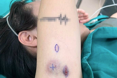 Phát hoảng vì nhiễm trùng, nổi u cục sau tiêm thuốc tiêu mỡ