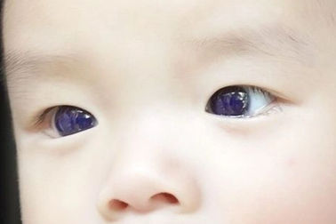 Sau điều trị Covid-19, em bé mắt nâu biến thành mắt xanh