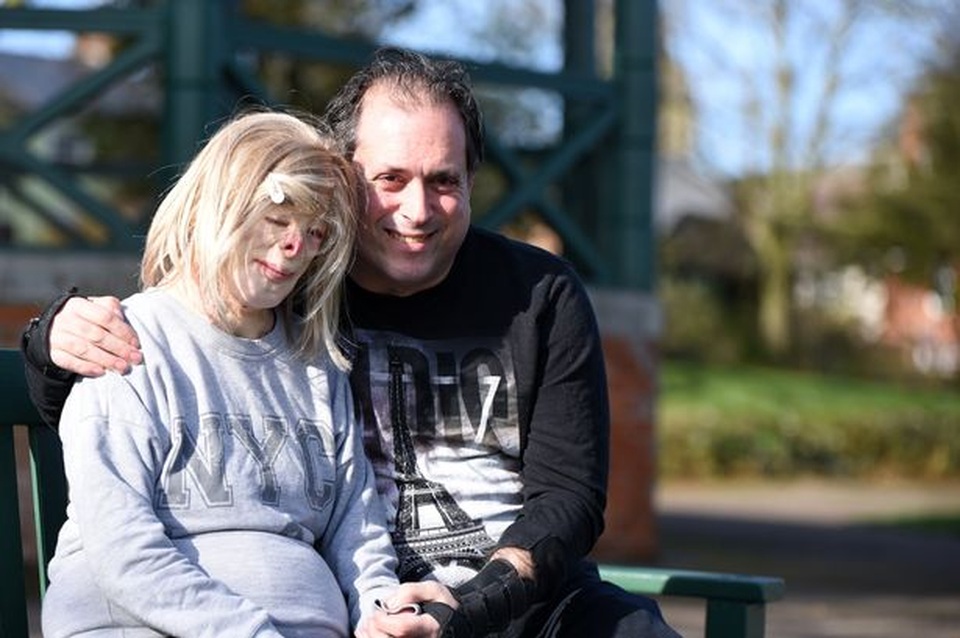 Hạnh phúc bất ngờ của cô gái từng bị bỏng đến biến dạng - 3