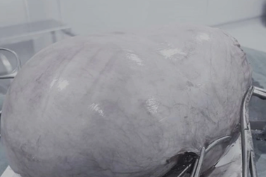 Cô gái 24 tuổi có khối u buồng trứng "khủng" nặng 8kg