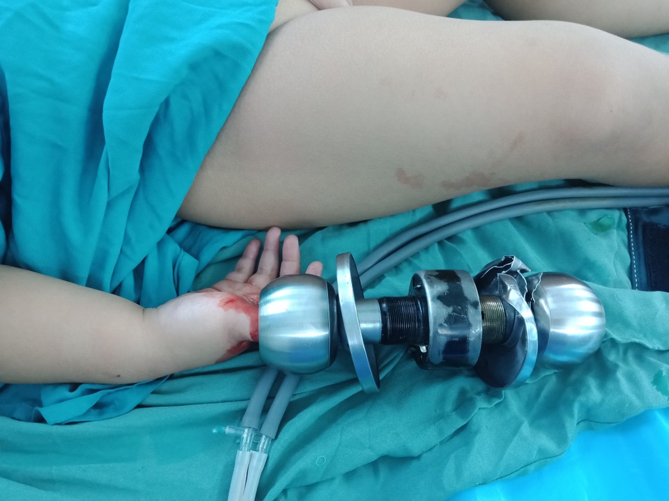 Bé trai 3 tuổi suýt mất ngón tay vì kẹt vào ổ khóa - 1