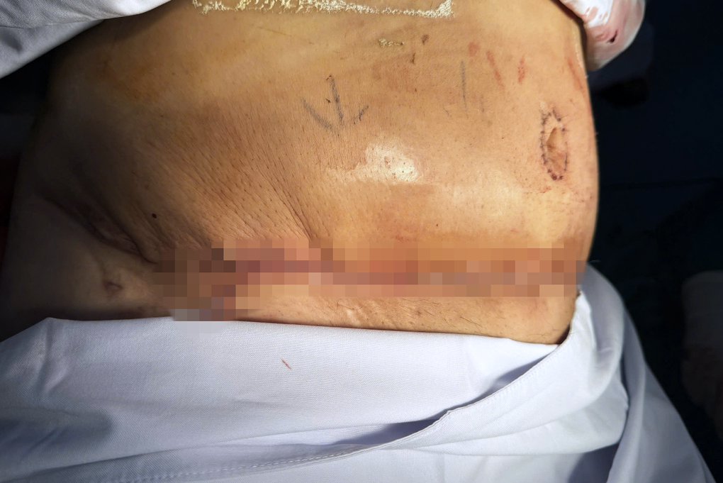Tốn trăm triệu, đánh đổi tính mạng đi hút mỡ, thực hiện combo làm đẹp - 2 Tốn trăm triệu, đánh đổi tính mạng đi hút mỡ, thực hiện combo làm đẹp - 2