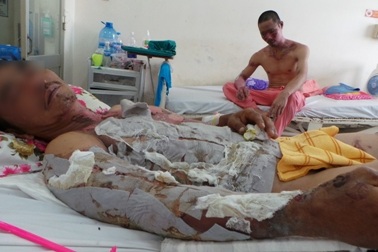 Vào bếp nấu cơm, 2 người bị bỏng ga nặng