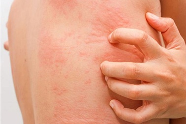 4 kiểu ngứa cần lưu ý vì có thể liên quan đến ung thư