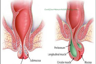 Tặng miễn phí sản phẩm hỗ trợ điều trị bệnh trĩ