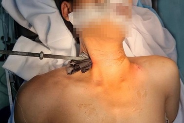 Nam thanh niên nhập viện với cây sắt đâm xuyên cổ