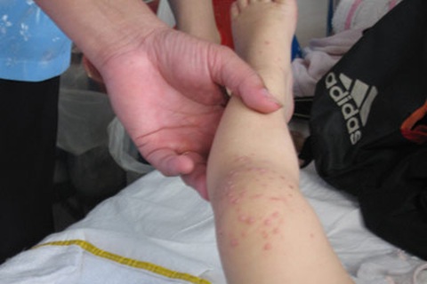 Miền Bắc: Có chủng vi-rút gây bệnh tay chân miệng nguy hiểm