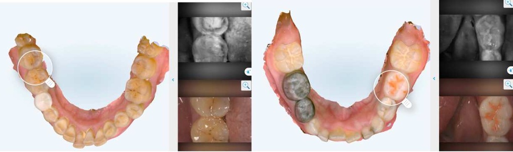 Ánh sáng cận hồng ngoại - phương pháp phát hiện sớm sâu răng mặt bên - 1 Ánh sáng cận hồng ngoại - phương pháp phát hiện sớm sâu răng mặt bên - 1