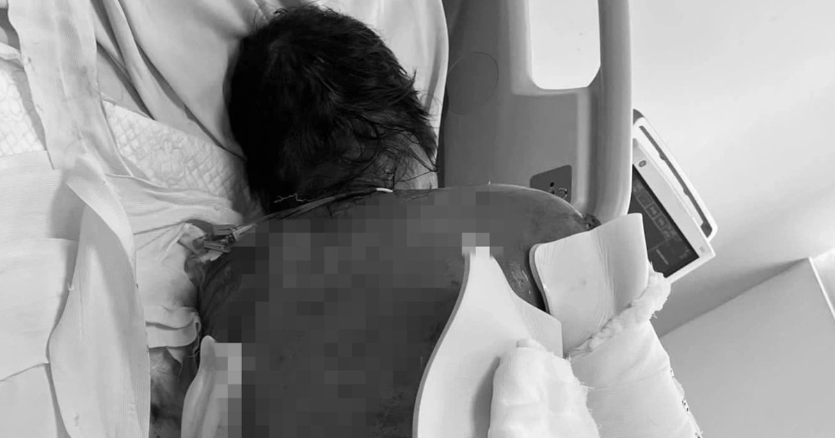 Hội chứng hiểm khiến người phụ nữ bong tróc da 92% sau khi dùng kháng sinh