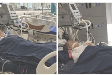 Cùng một ngày, 3 bệnh nhi bị ong đốt nguy kịch