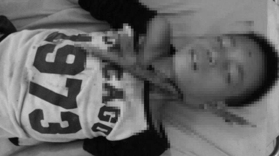 Thiếu niên 12 tuổi bị cành cây dài 0,4m đâm xuyên vào cổ - 1