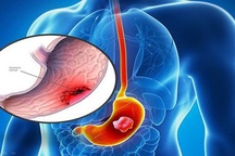 Chuyên gia chỉ rõ "thủ phạm" chính gây ung thư dạ dày, ai cũng nên biết để tránh