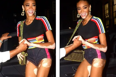 Winnie Harlow khoe dáng thon bốc lửa