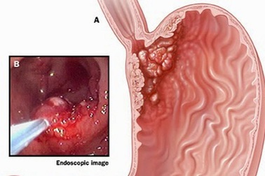 7 dấu hiệu cảnh báo ung thư dạ dày đã ở giai đoạn muộn