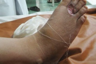 Hơn 60% người bị đái tháo đường không biết mình mắc bệnh