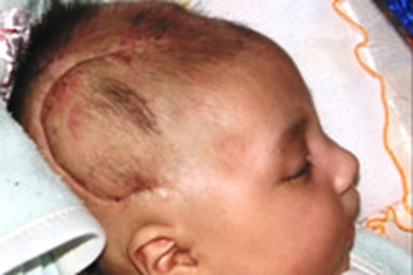 Cứu sống trẻ 40 ngày tuổi bị chấn thương sọ não nặng