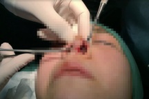 Chủ thẩm mỹ viện "hô biến" thành bác sĩ để nâng mũi, cắt môi khách