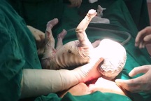 Cô gái 15 tuổi sinh con toàn thân bọc vảy trắng, da nứt nẻ, chảy máu