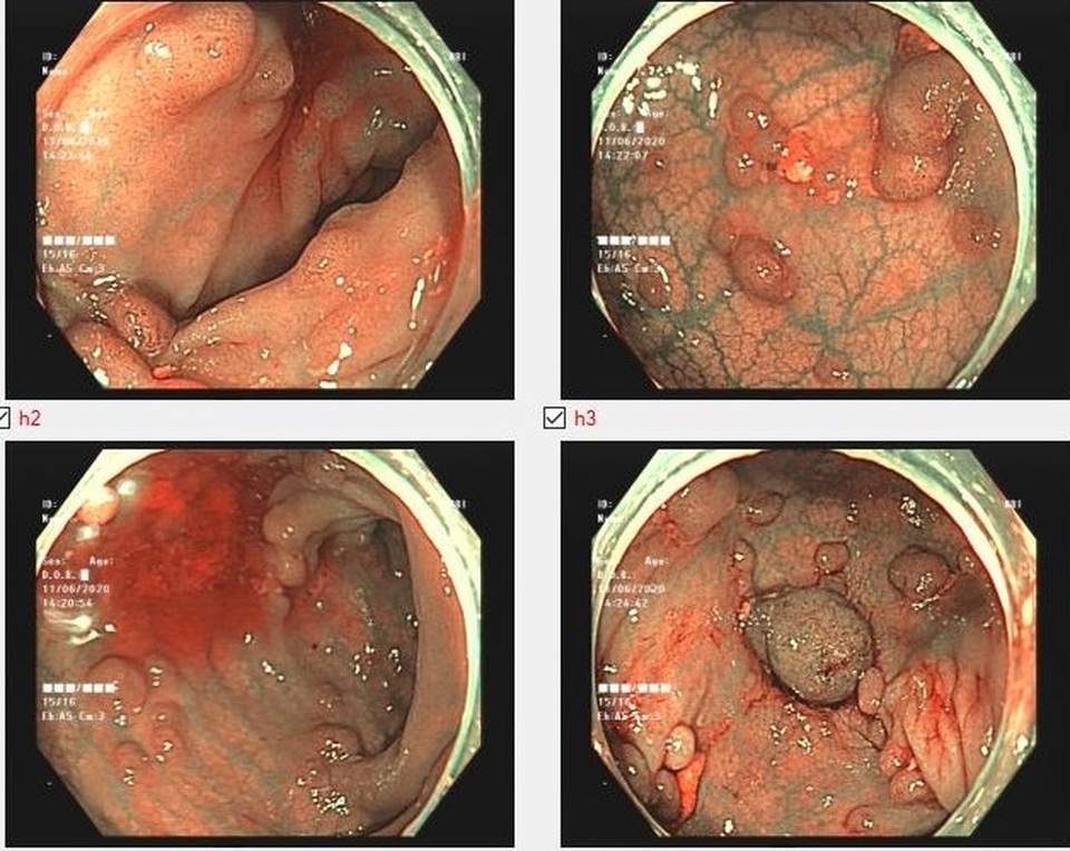 Đi ngoài ra máu, người phụ nữ phát hiện hơn 100 polyp trong đại tràng - 1 Đi ngoài ra máu, người phụ nữ phát hiện hơn 100 polyp trong đại tràng - 1