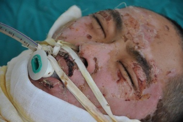 Em Quân bỏng vì nướng cá bằng cồn đã mãi mãi ra đi