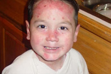 Hành trình chữa bệnh kỳ diệu của cậu bé "lột da" ở Mỹ