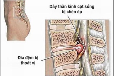 Phát hiện thoát vị đĩa đệm từ chứng đau lưng