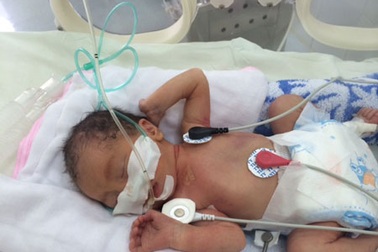 Lần đầu tiên thành công kỹ thuật thở máy không xâm nhập trên bệnh nhi sơ sinh đẻ non