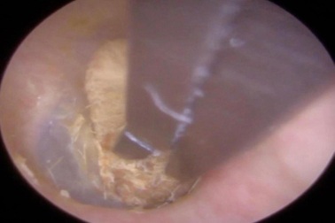 Có cục bông mắc kẹt trong tai từ 2 năm trước mà không hề hay biết