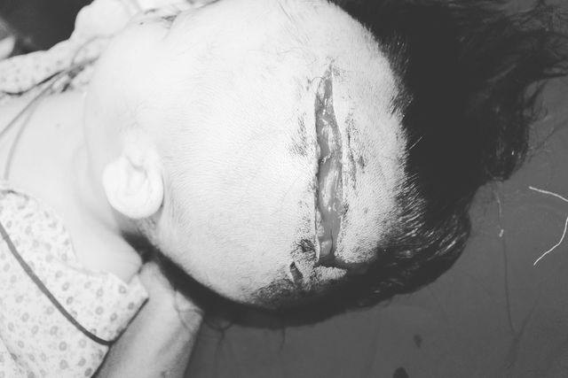 Hà Nội: Bé 2 tuổi rách đầu, lộ xương sọ do bị chó  tấn công
