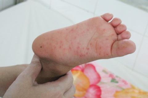 Xuất hiện bệnh nhân tay chân miệng tại Hà Nội