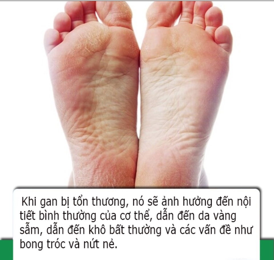 Bàn chân có 4 dấu hiệu này cho biết sức khỏe lá gan của bạn đang suy giảm - 2 Bàn chân có 4 dấu hiệu này cho biết sức khỏe lá gan của bạn đang suy giảm - 2