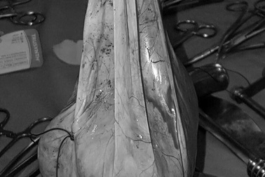 Lấy thành công khối u nang buồng trứng 6 kg trong bụng cụ bà trăm tuổi