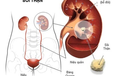 Vì sao sỏi thận có thể gây suy thận? 