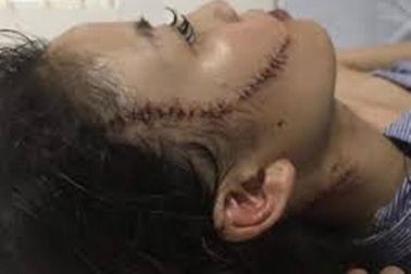 Ghen tuông, cầm dao rạch mặt vợ hờ