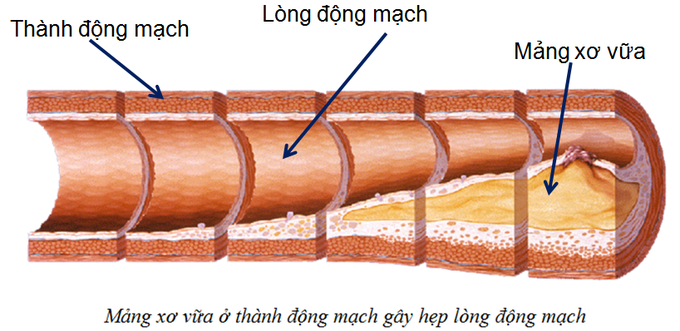 Căn bệnh phổ biến trong cộng đồng là nguyên nhân hàng đầu gây tử vong trên toàn thế giới - Ảnh 4. Căn bệnh phổ biến trong cộng đồng là nguyên nhân hàng đầu gây tử vong trên toàn thế giới - Ảnh 4.