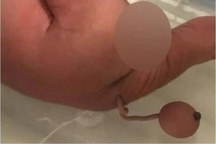 Cậu bé sinh ra với chiếc đuôi dài 12 cm