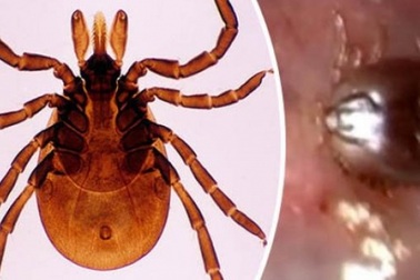 Video: Sinh vật 8 chân hút máu bám chặt tai người không rời