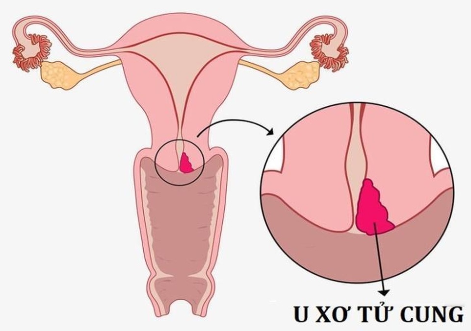 Kinh nguyệt kéo dài – Dấu hiệu u xơ tử cung và giải pháp cải thiện an toàn từ Nga Phụ Khang - 2 Kinh nguyệt kéo dài – Dấu hiệu u xơ tử cung và giải pháp cải thiện an toàn từ Nga Phụ Khang - 2