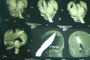 Kỳ tích cứu bé sơ sinh bị dao bầu đâm xuyên đầu