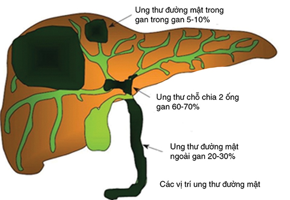 Vàng da có thể là một dấu hiệu của ung thư đường mật - 1 Vàng da có thể là một dấu hiệu của ung thư đường mật - 1