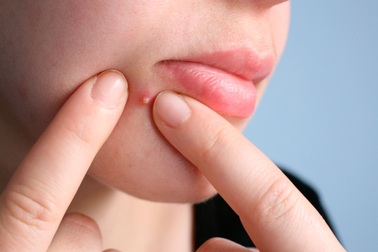 Tại sao bạn không nên tự nặn mụn?