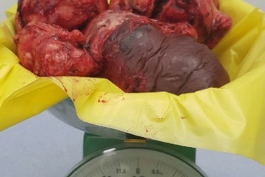 Người đàn ông “mang bầu” 15 năm được bác sĩ giải cứu