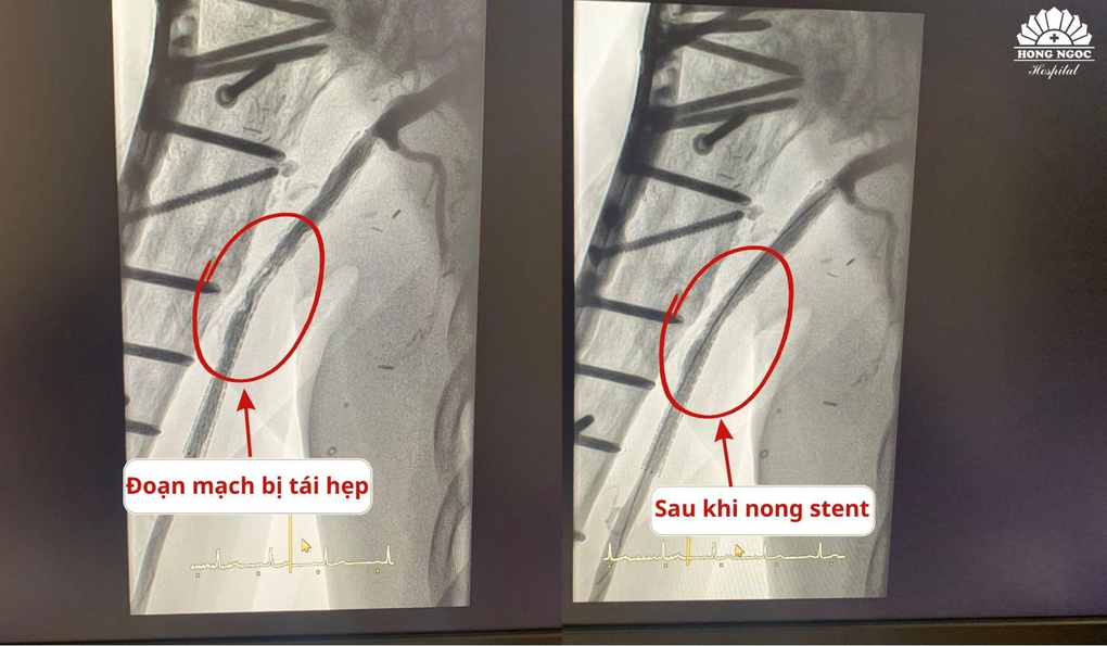 Nong stent hẹp 99% ở cánh tay bệnh nhân đang cố định hàng chục chiếc đinh - 1 Nong stent hẹp 99% ở cánh tay bệnh nhân đang cố định hàng chục chiếc đinh - 1