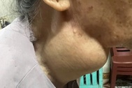 Cụ bà 88 tuổi bị khối u giáp khổng lồ chèn ép đường thở suốt 18 năm