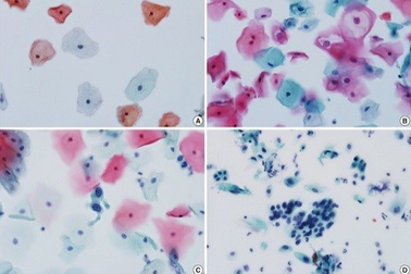 Sàng lọc ung thư cổ tử cung bằng xét nghiệm ThinPAS