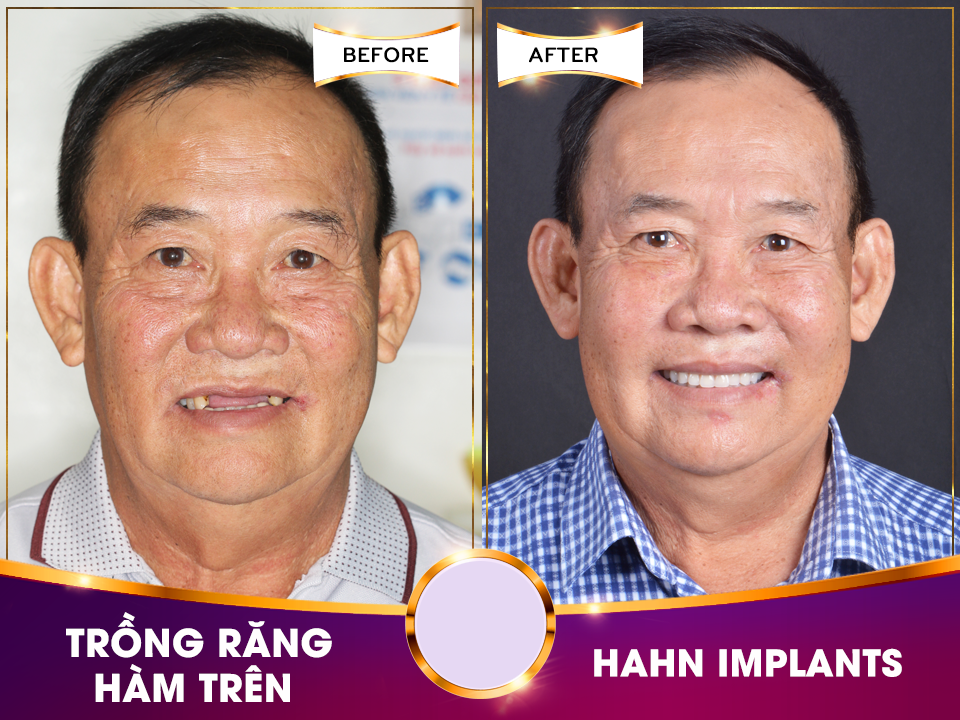 Implant nào phù hợp cho người Việt - 3