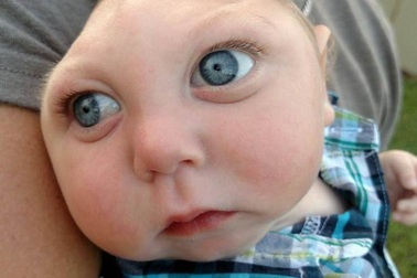 Bé dị tật não bẩm sinh chỉ có nửa hộp sọ